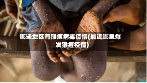 哪些地区有猴痘病毒疫情(最近哪里爆发猴痘疫情)